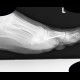 Foreign body in the foot, pipette: X-ray - Plain radiograph